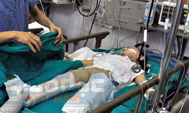 Sức khỏe cháu bé vụ nổ xe máy tiến triển tốt hơn