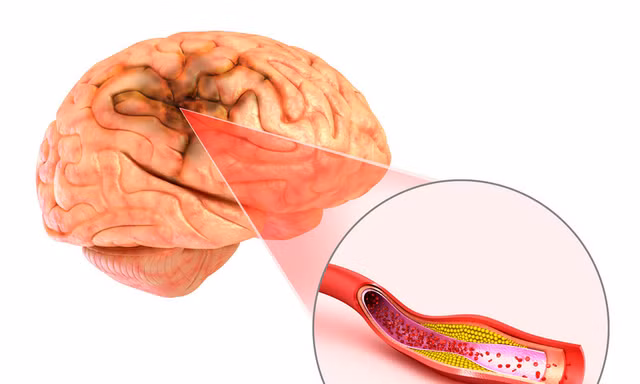 Đột quỵ não và vai trò của chụp cộng hưởng từ (MRI) trong tầm soát đột quỵ