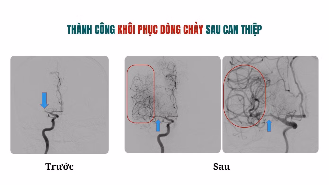 Sau can thiệp, dòng máu lên não được khôi phục