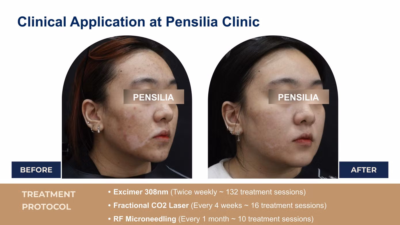 Kết quả sau liệu trình điều trị cho khách hàng tại Pensilia