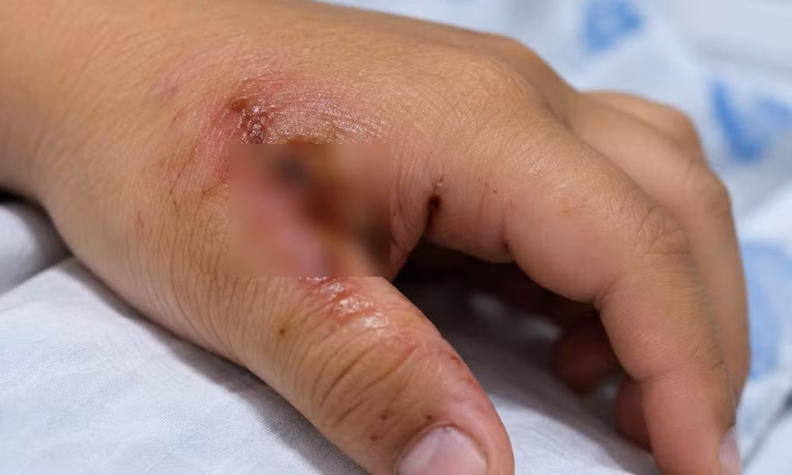 Uốn ván nặng, bé trai 7 tuổi co giật liên tục