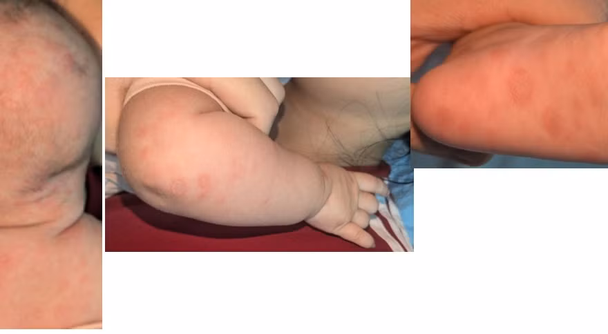 Nhiều trẻ mắc giang mai bẩm sinh vì mẹ bỏ lỡ xét nghiệm quan trọng