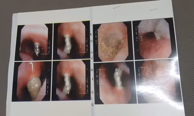 Bệnh nhân N.C.K bị 4 chiếc đinh vít nong hàm chọc thẳng lên mũi. Ảnh: NVCC. 