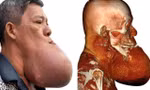 Cứu bệnh nhân bị 'nổ tung' khối u khổng lồ