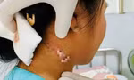 TPHCM: Phát hiện ca bệnh nhiễm 'vi khuẩn ăn thịt người' 