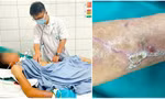 Cứng hàm, suy hô hấp vì vết xước nhỏ, cảnh báo 'đặc biệt' từ hai ca uốn ván nặng