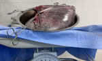 Bé trai được sinh ra cùng khối u nang buồng trứng 8kg trong bụng mẹ