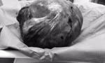 Lấy khối u nặng hơn 4 kg khỏi cơ thể người phụ nữ tại Cần Thơ 