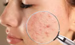 Muốn trị mụn tận gốc phải hiểu đúng về từng loại mụn