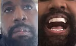 Gương mặt biến dạng của Kanye West sau khi nhổ hết răng