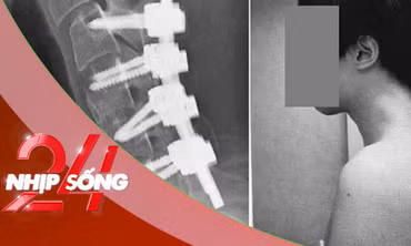 NHỊP SỐNG 24: Thanh niên mắc ‘hội chứng rụng đầu' vì dùng điện thoại