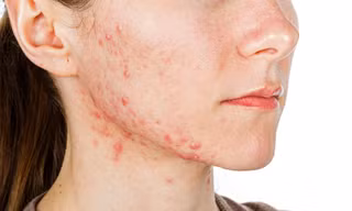 Tuổi dậy thì dễ mắc những bệnh gì? 