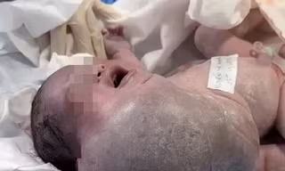 Bé trai vừa chào đời đã đối mặt với nguy cơ tử vong vì khối bướu khổng lồ hiếm gặp 