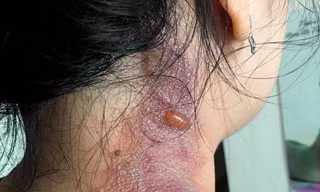 Nhiều bệnh nhân COVID-19 bị kiến ba khoang 'tấn công'