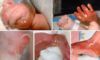 Bé gái tróc da toàn thân vì bệnh lý cực hiếm gặp do đột biến gen