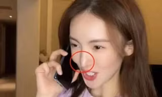 Nữ diễn viên Kim Thần bị biến dạng gương mặt