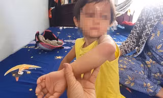 Làm rõ vụ bé gái 4 tuổi bị cha nuôi đánh gây thương tích 