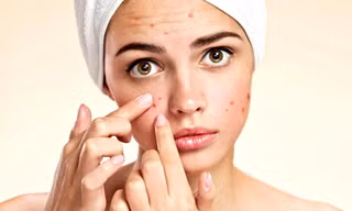 Mụn à? Cứ mặc kệ nó! Bạn càng lo lắng về mụn thì nó càng xuất hiện nhiều hơn