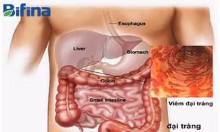 Mách bạn bí kíp hết khổ vì viêm đại tràng 