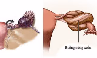 Bé gái hơn 1 tuổi ở Nghệ An phải cắt bỏ buồng trứng 