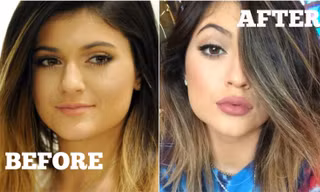Tại sao mọi người đều tiêm filler làm đầy môi? Những khao khát dấu đằng sau mốt môi dày