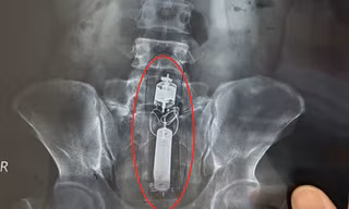 Sextoy kẹt trong trực tràng nam thanh niên.