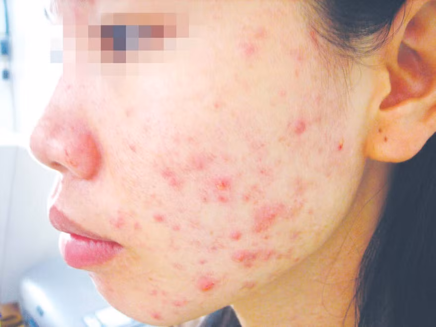 Một nạn nhân của dị ứng mỹ phẩm