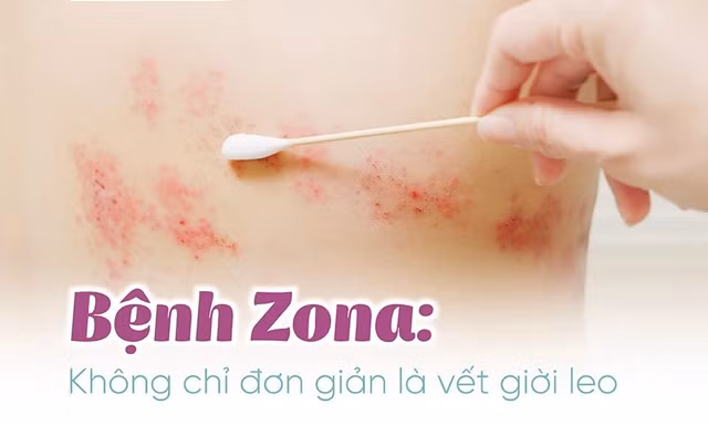 Zona thần kinh: Căn bệnh dễ gặp, biến chứng khó lường