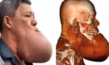 Cứu bệnh nhân bị 'nổ tung' khối u khổng lồ
