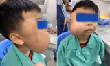 Bé trai bị khối u chiếm trọn khuôn mặt bên phải.