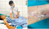 Cứng hàm, suy hô hấp vì vết xước nhỏ, cảnh báo 'đặc biệt' từ hai ca uốn ván nặng