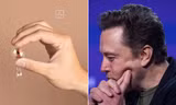 Con chip lần đầu tiên được cấy vào não người của Elon Musk nảy sinh vấn đề
