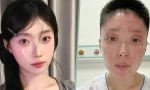 Hành trình phục hồi của cô gái xinh đẹp bị biến dạng mặt do nổ khí gas