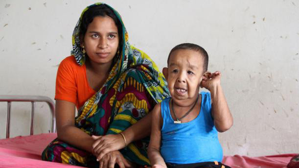 Cậu bé 4 tuổi có ngoại hình như ông lão 80