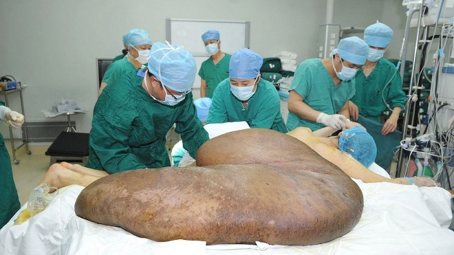Người đàn ông có khối u nặng 110kg