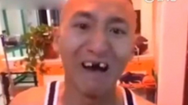 Chàng trai mất hết răng cửa vì tham gia thử thách ăn ngô bằng máy khoan