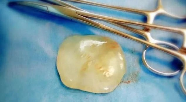 "Viên ngọc" rơi ra từ bụng sản phụ trong quá trình mổ đẻ ở Trung Quốc.