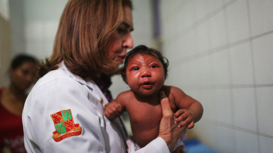 Một em bé bị dị tật đầu nhỏ do virus zika