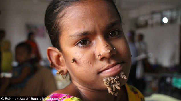 Các bác sỹ tại Bệnh viện Đại học Y Dhaka nghi ngờ Khatun mắc "hội chứng người cây".