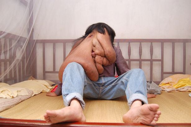 Bức ảnh chụp ảnh Huang tại nhà hồi chưa phẫu thuật 