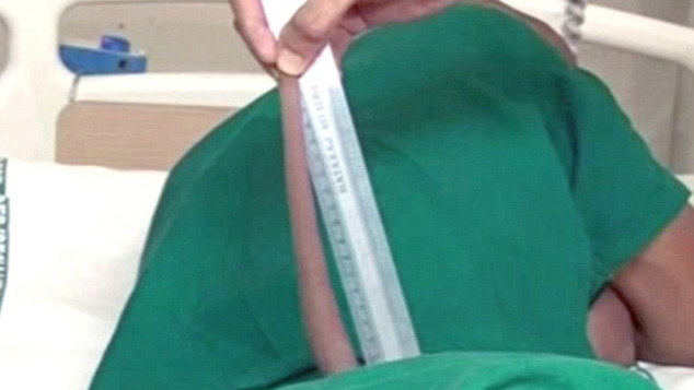 Chiếc đuôi dài tới 18 cm của thiếu niên ở Ấn Độ.