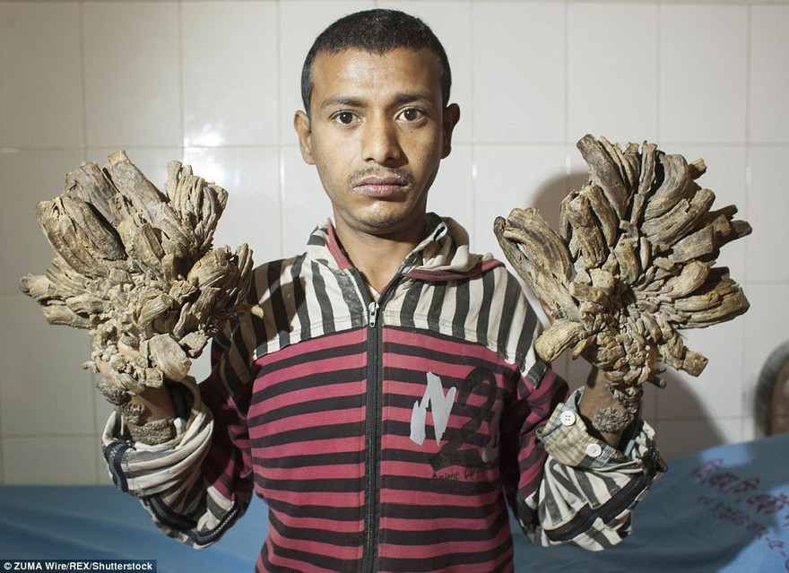 Chàng trai mắc bệnh lạ mọc 'rễ cây' trên người