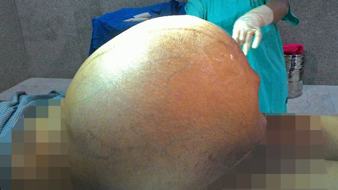 Chị Kamlesh Devi phải trải qua ca phẫu thuật kéo dài 3 tiếng đồng hồ để lấy khối u nặng 95kg