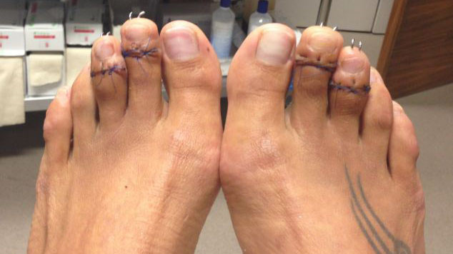 Chân của Paulina sau khi được phẫu thuật cưa ngắn