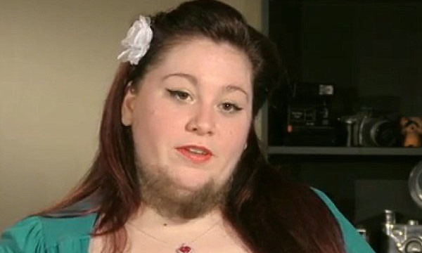 Mắc bệnh lạ, người phụ nữ mọc râu quai nón như đàn ông