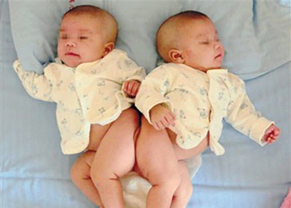 Cặp song sinh dính liền 12 tuần tuổi.