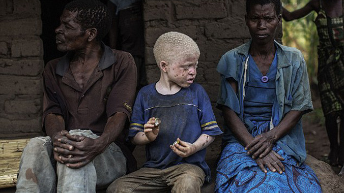 Hãi hùng nạn săn lùng người bạch tạng để lấy bộ phận cơ thể