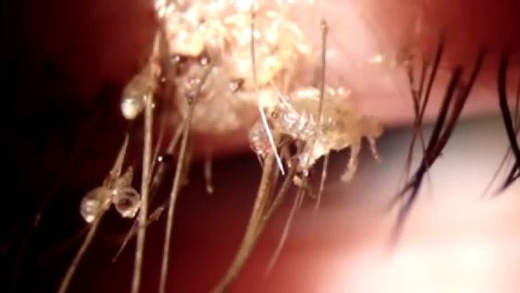 Cô Zhang vô cùng hoảng hốt khi biết chấy ký sinh trên mi mắt mình