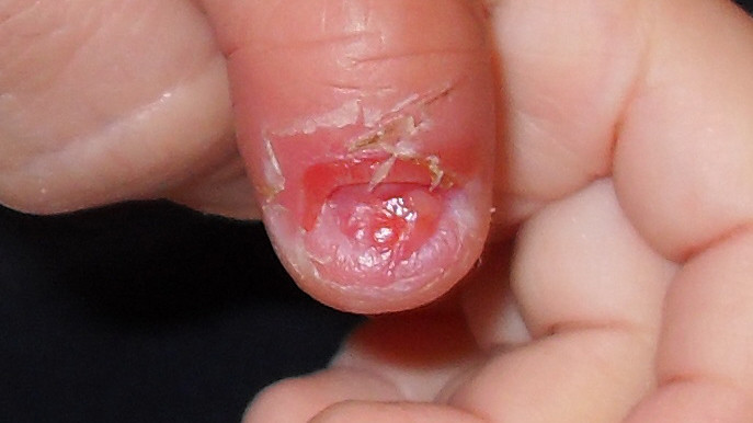 Hoảng hốt vì hàng loạt trẻ mầm non bị bong móng tay