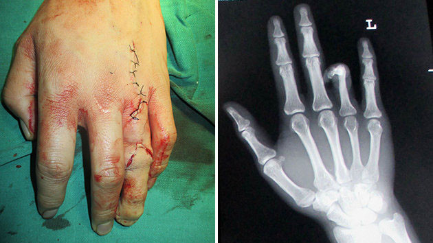 Ghép ngón chân vào bàn tay để... dễ xin việc